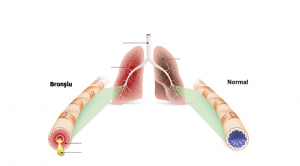 Bronşit Nedir, Nasıl Geçer?