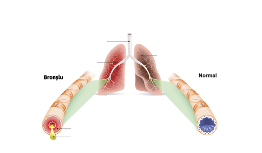 Bronşit Nedir Nasıl Geçer