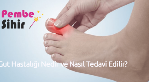 Gut Hastalığı Nedir ve Nasıl Tedavi Edilir?