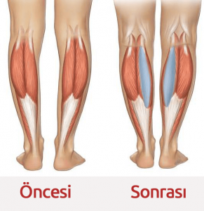 Çarpık Bacak Estetiği Öncesi Sonrası