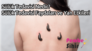 Sülük Tedavisi Nedir? Sülük Tedavisi Faydaları ve Yan Etkileri