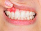 Diş İltihabına Ne İyi Gelir: Doğal Yöntemler ve Tedaviler