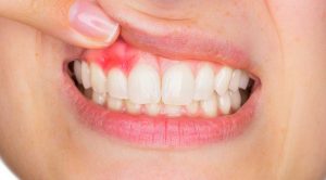 Diş İltihabına Ne İyi Gelir: Doğal Yöntemler ve Tedaviler